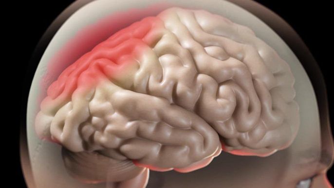 Phù não trong u não và phương pháp điều trị hiệu quả